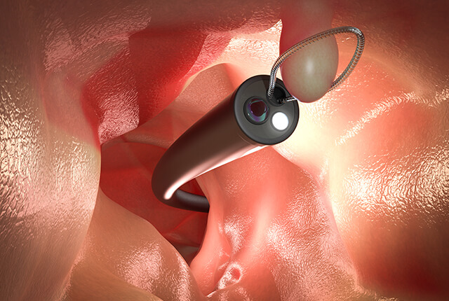 大腸ポリープ切除のイメージ