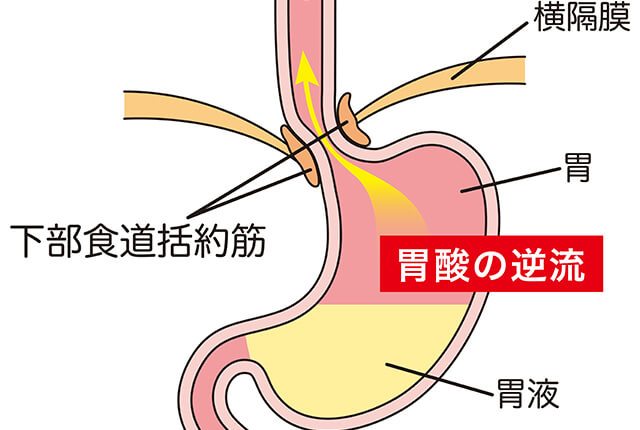 胃酸が逆流するイメージのイラスト