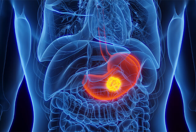 胃がんをイメージしたイラスト